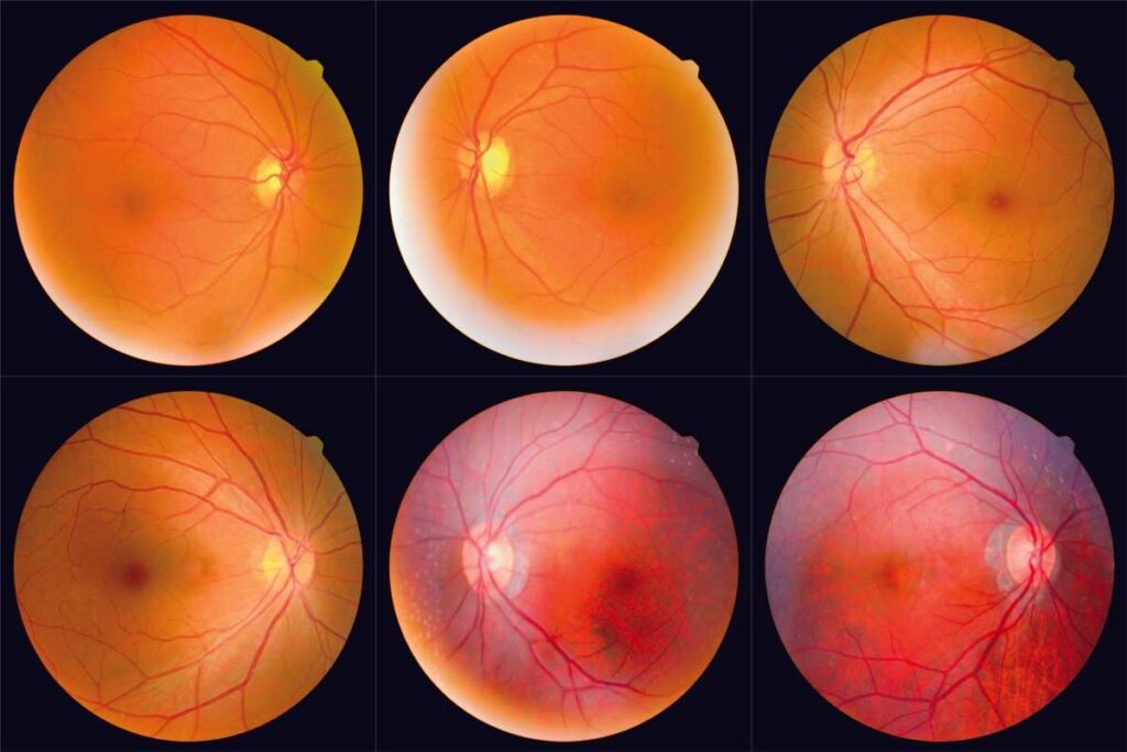 Set of retinal images comparing healthy eyes with retinas affected by eye diseases such as diabetic retinopathy and macular degeneration.