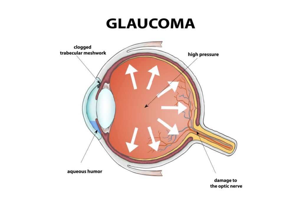 Medical diagram showing cross-section of eye with glaucoma, illustrating clogged trabecular meshwork causing high intraocular pressure and damage to optic nerve, with labeled aqueous humor fluid buildup.