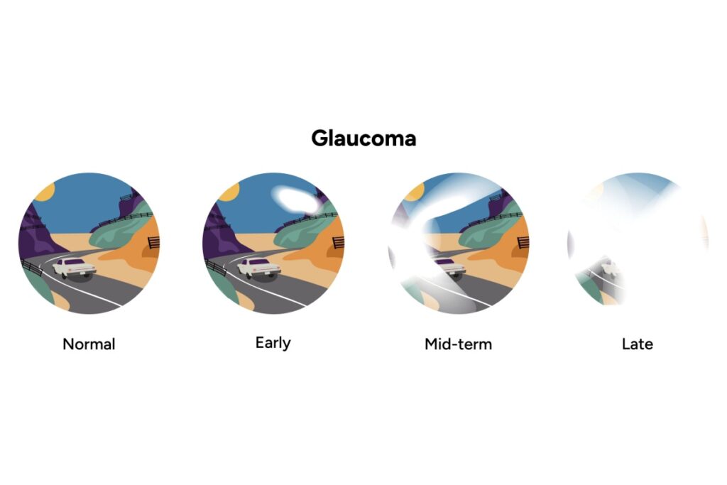 Four-stage progression of glaucoma vision loss showing driving scene from normal vision to early, mid-term, and late-stage tunnel vision, demonstrating gradual loss of peripheral vision while central vision remains.